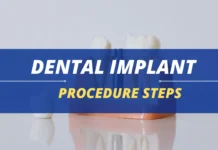Dental Implant Procedure Steps Dental Implant Procedure Steps
