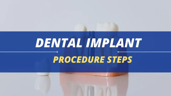 Dental Implant Procedure Steps
