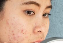 Which Peel is Best for Acne Scars? Acne Scars